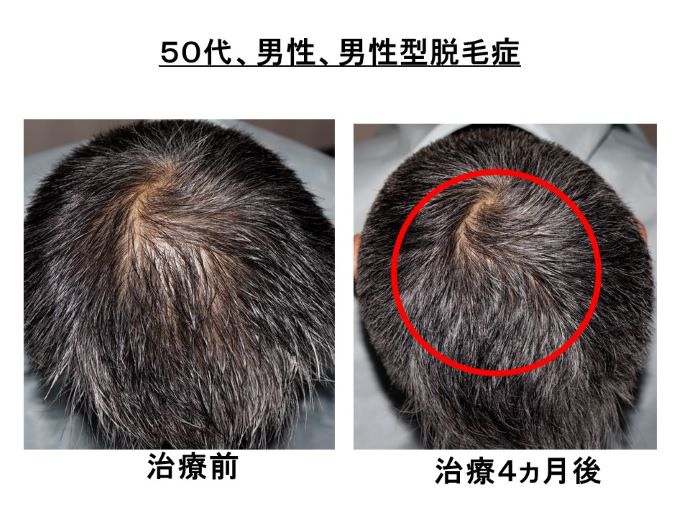 円形脱毛症　病院